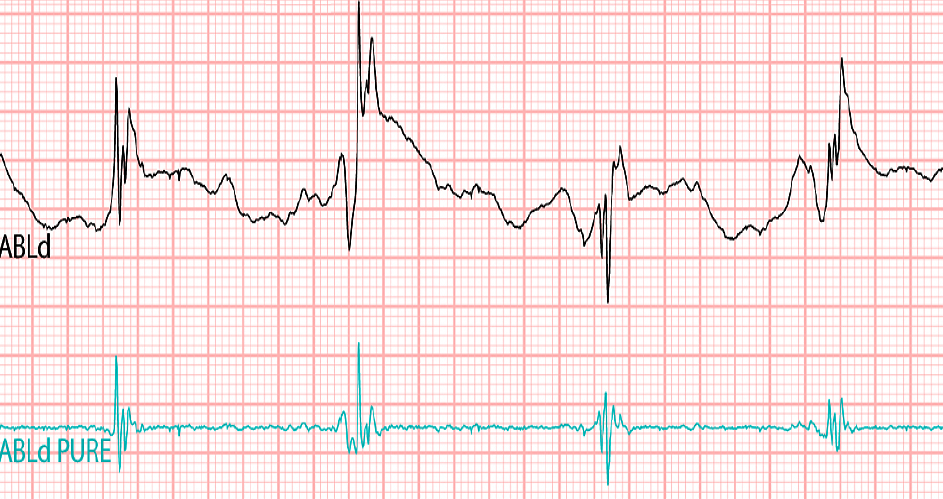 Conventional Electrophysiology Reading (Top) versus the PURE EP System's Reading (Bottom)